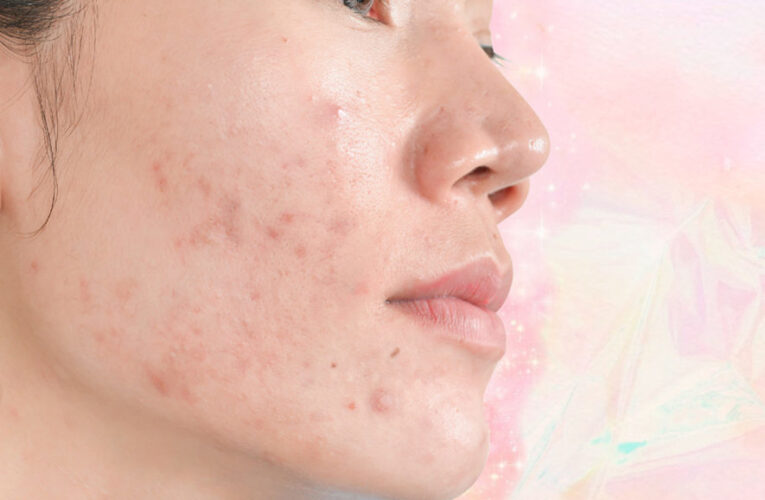 What is the most effective acne skincare routine?